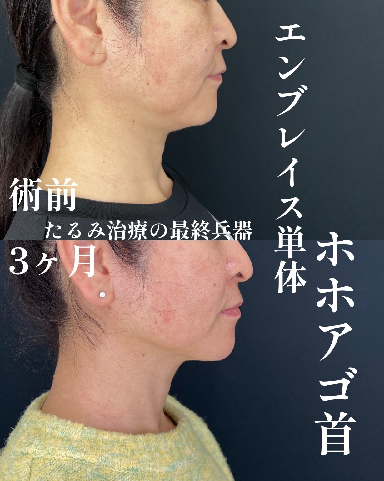 たるみ治療の最終兵器💖