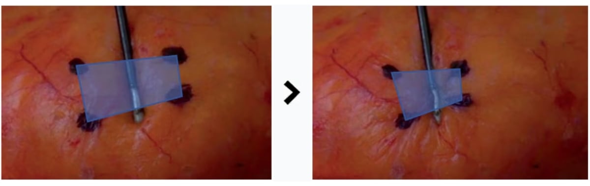 エンブレイスRFのタイトニング効果