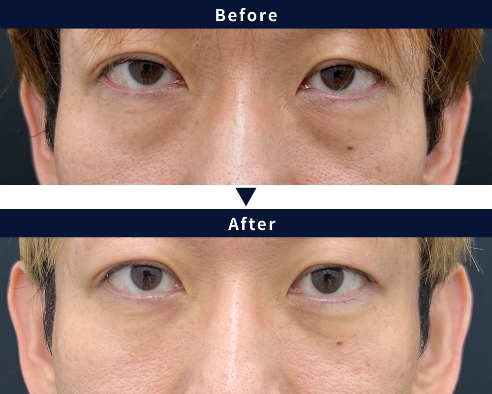 満安医師のクマ取り症例