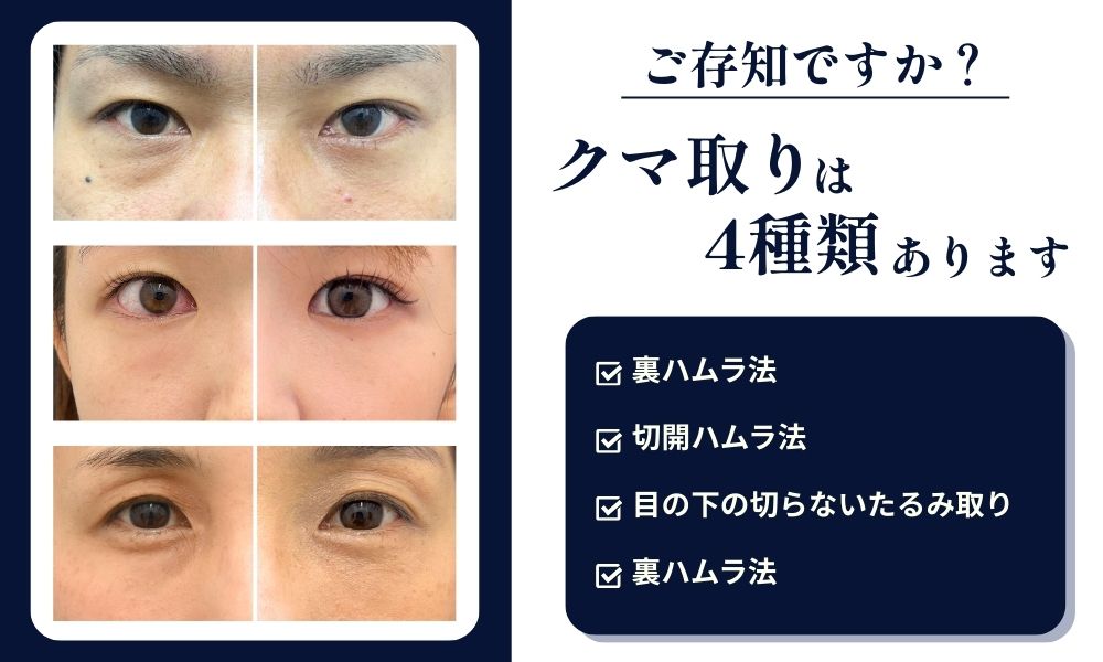 《クマとりが4種類あるの、ご存知ですか？》