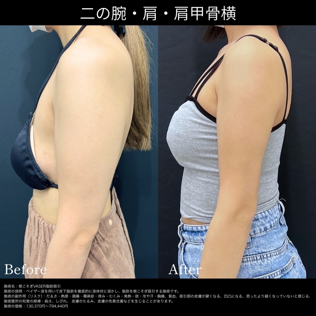 二の腕の脂肪吸引