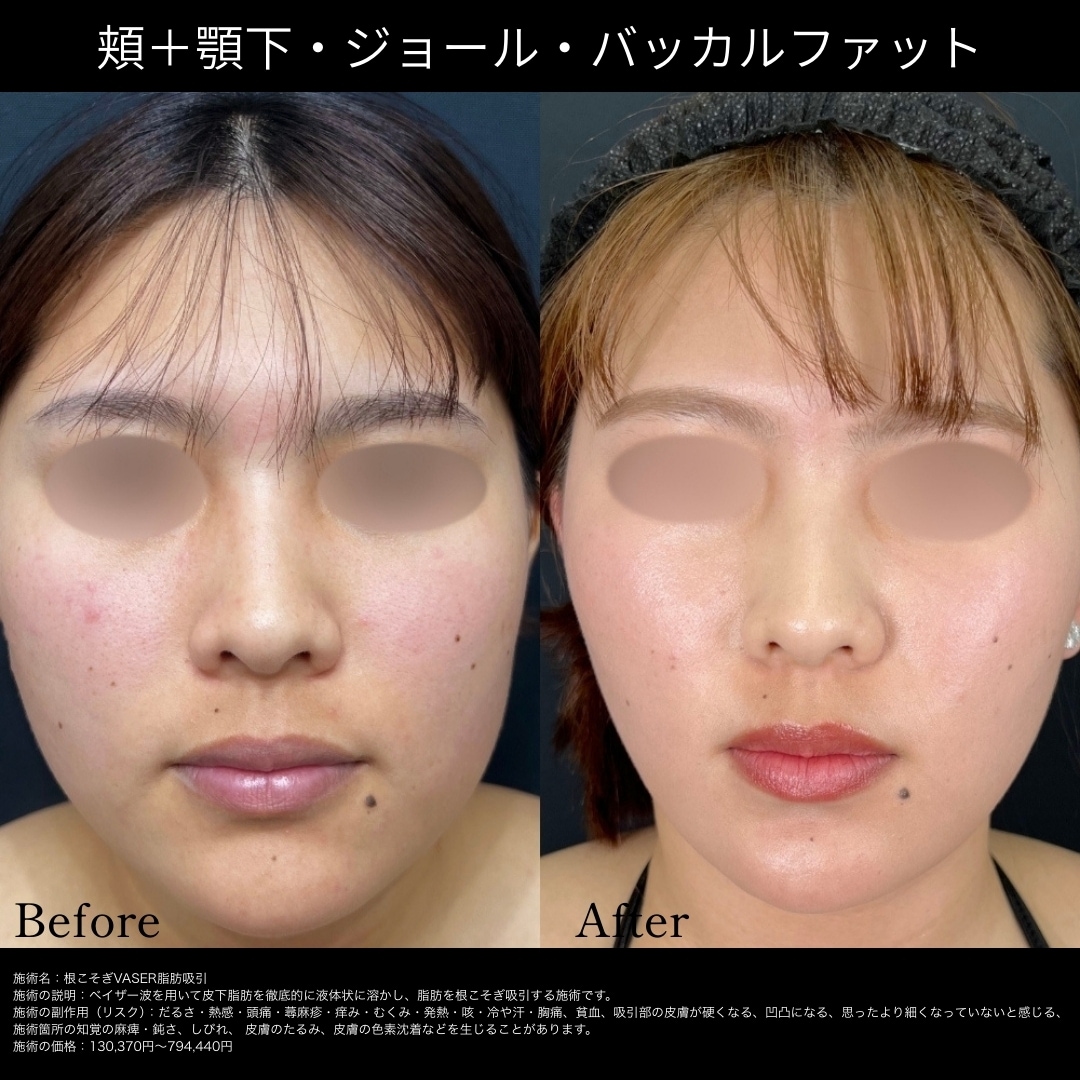 顔の脂肪吸引