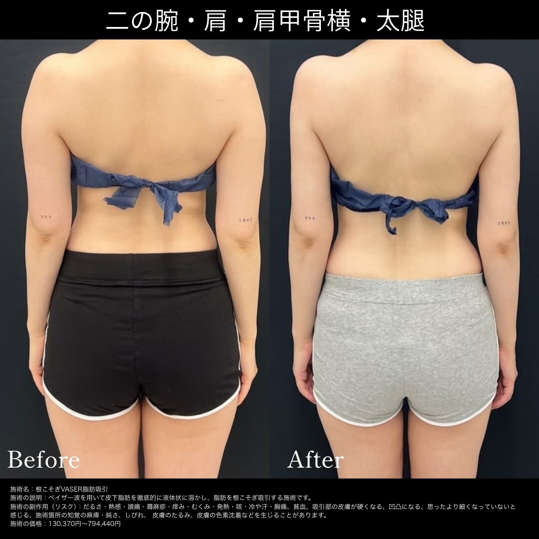 二の腕と足の脂肪吸引