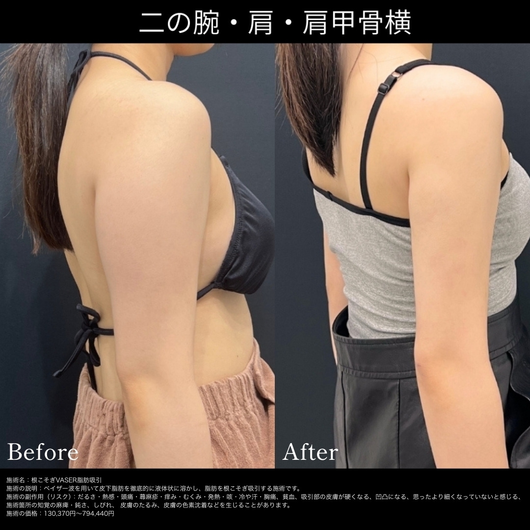 二の腕の脂肪吸引