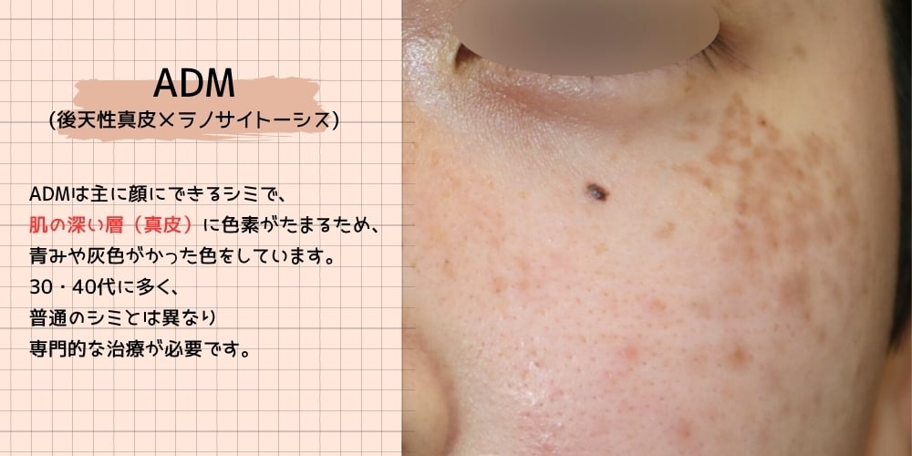ADA(後天性真皮メラノサイトーシス)