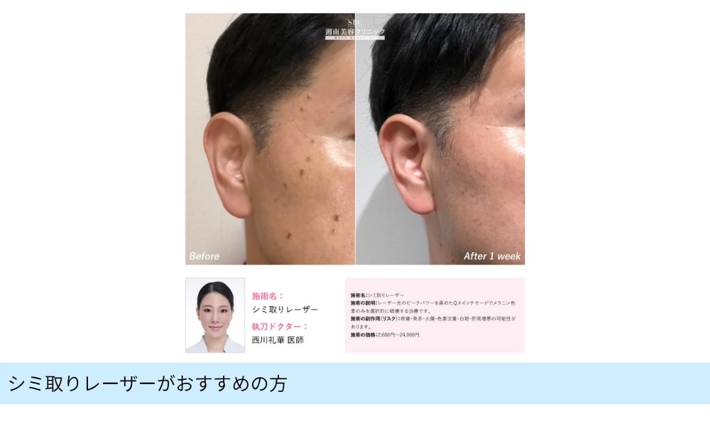 シミ取りレーザー