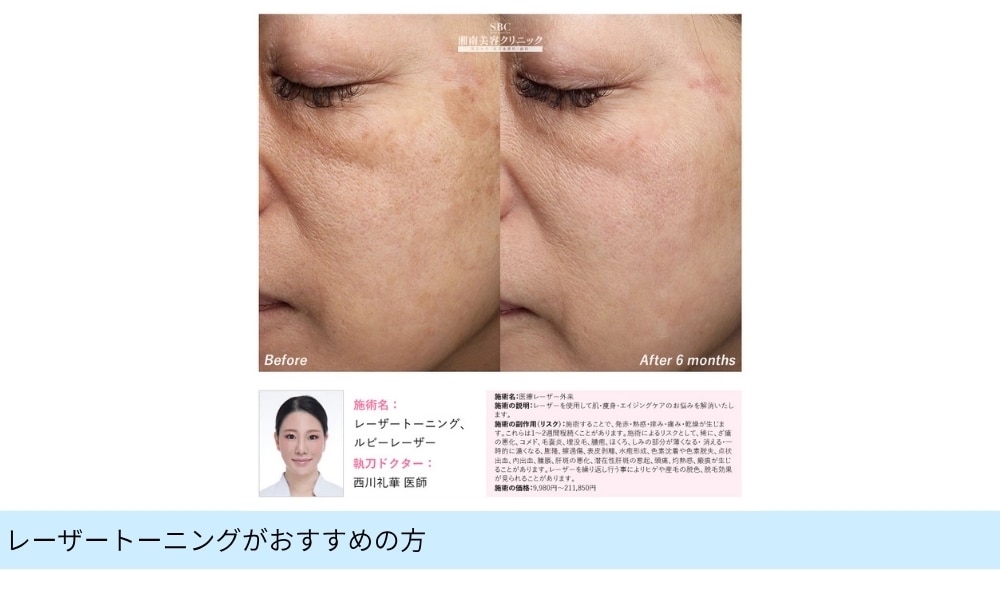 レーザートーニング