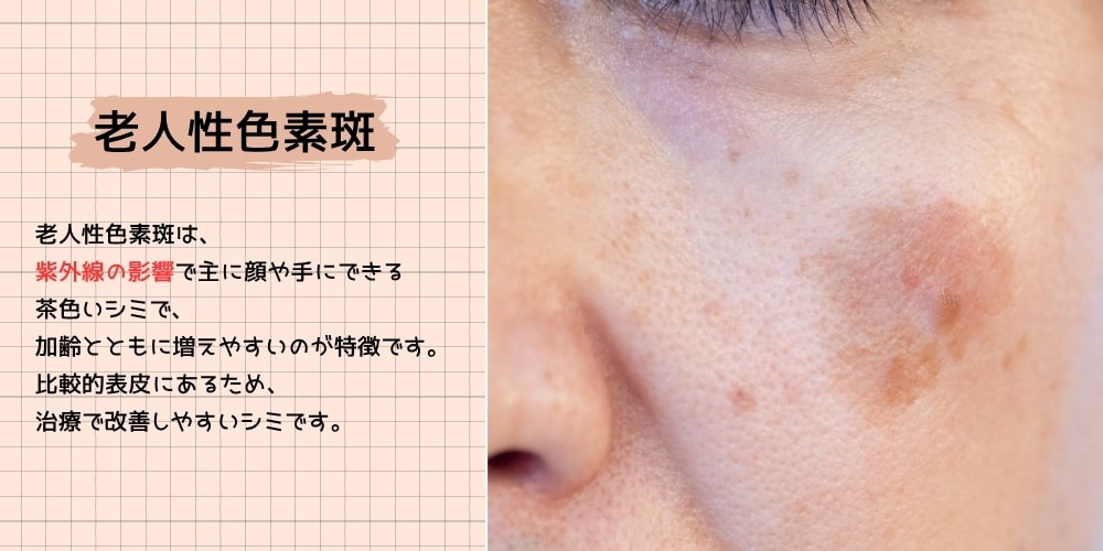 老人性色素斑