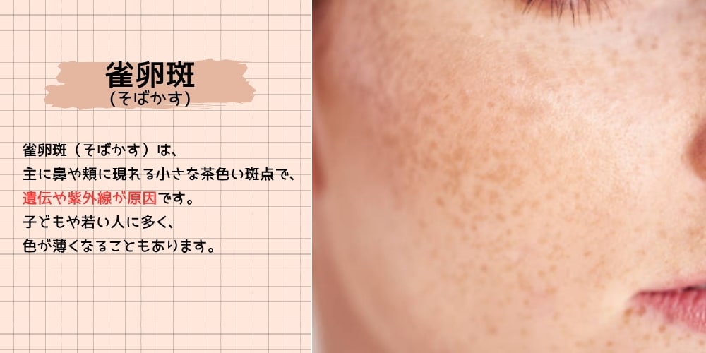 雀卵斑（そばかす）