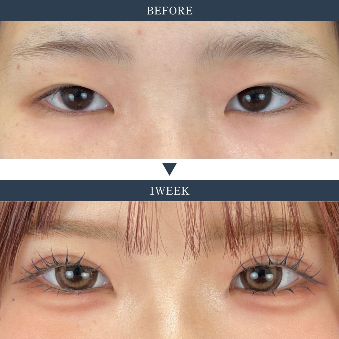 ついに解禁!!クイックコスメティーク・トリプルNeoが姫路院でもご案内可能に