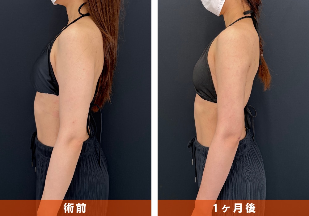 【二の腕の脂肪吸引】背中・肩まわりの厚みカット