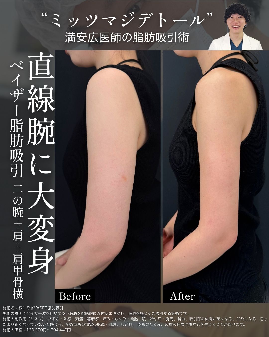 二の腕もアップデート