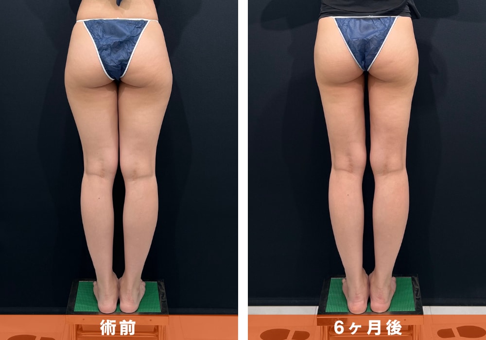 【太ももの脂肪吸引】隙間のある引き締め脚