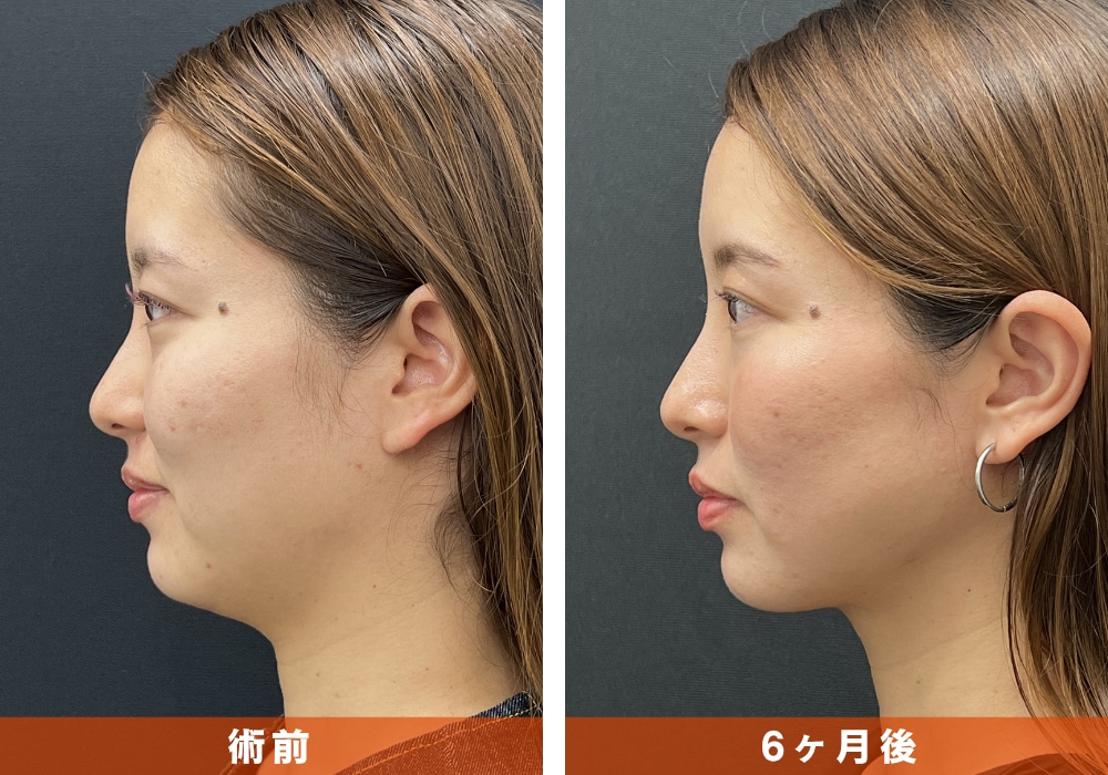 【顔の脂肪吸引】年齢によるもたつき解消、二重あご改善