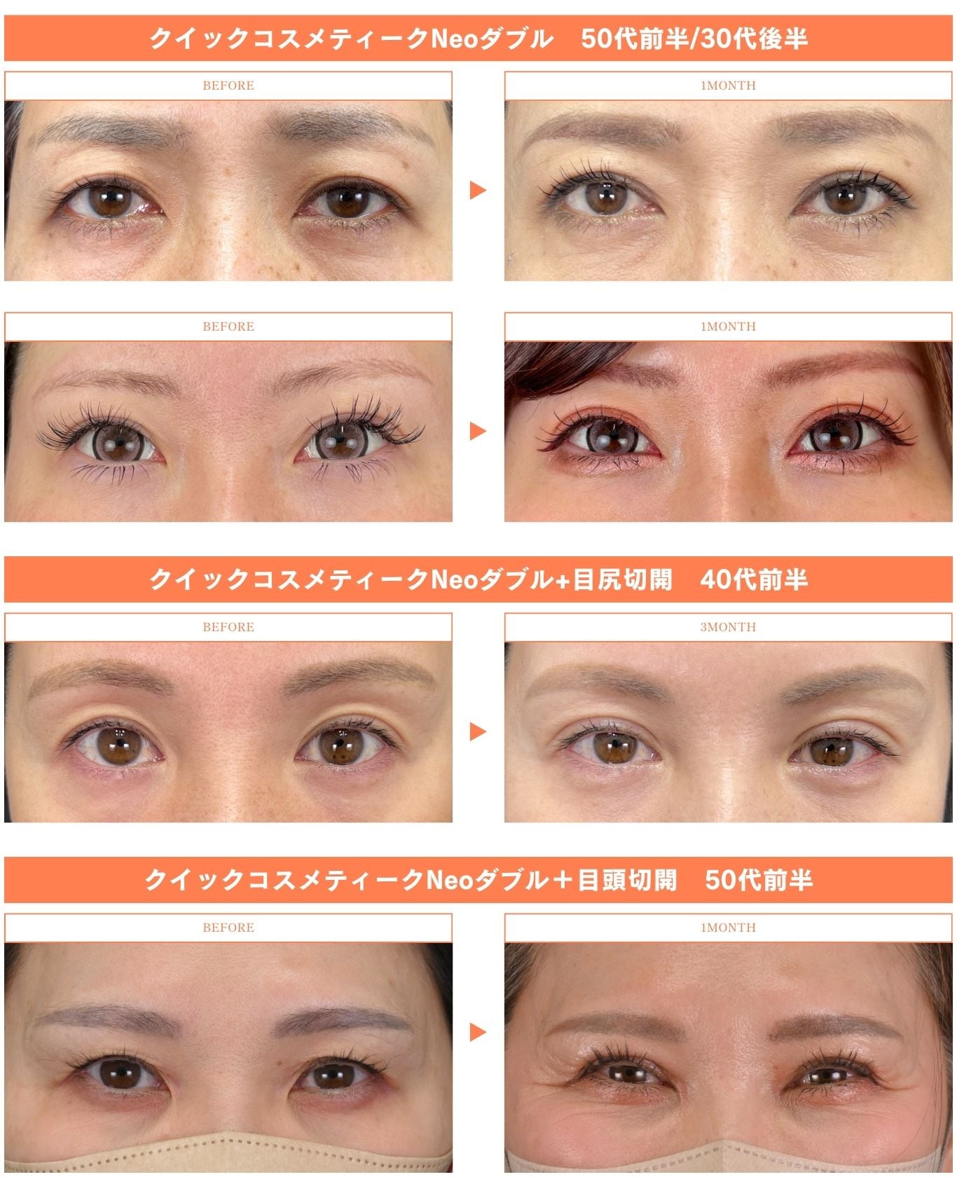 ミドル世代の二重整形症例