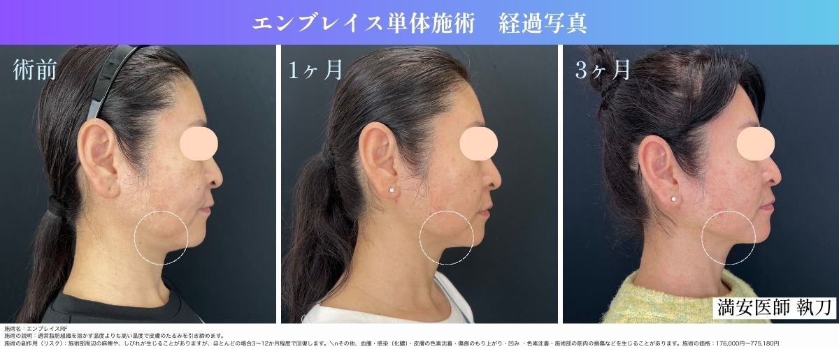 たるみ治療の最終兵器💖