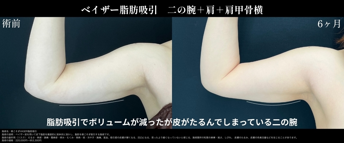 脂肪吸引のデメリットを解消！！