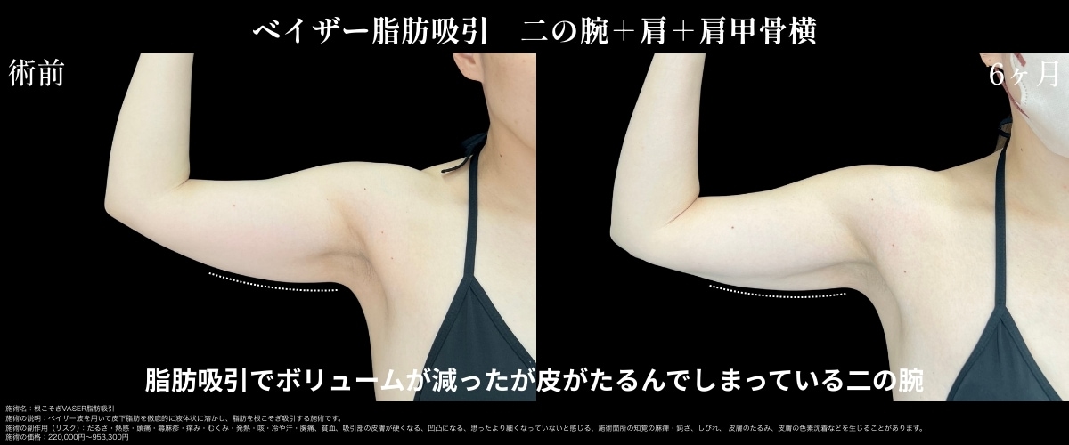 脂肪吸引のデメリットを解消！！