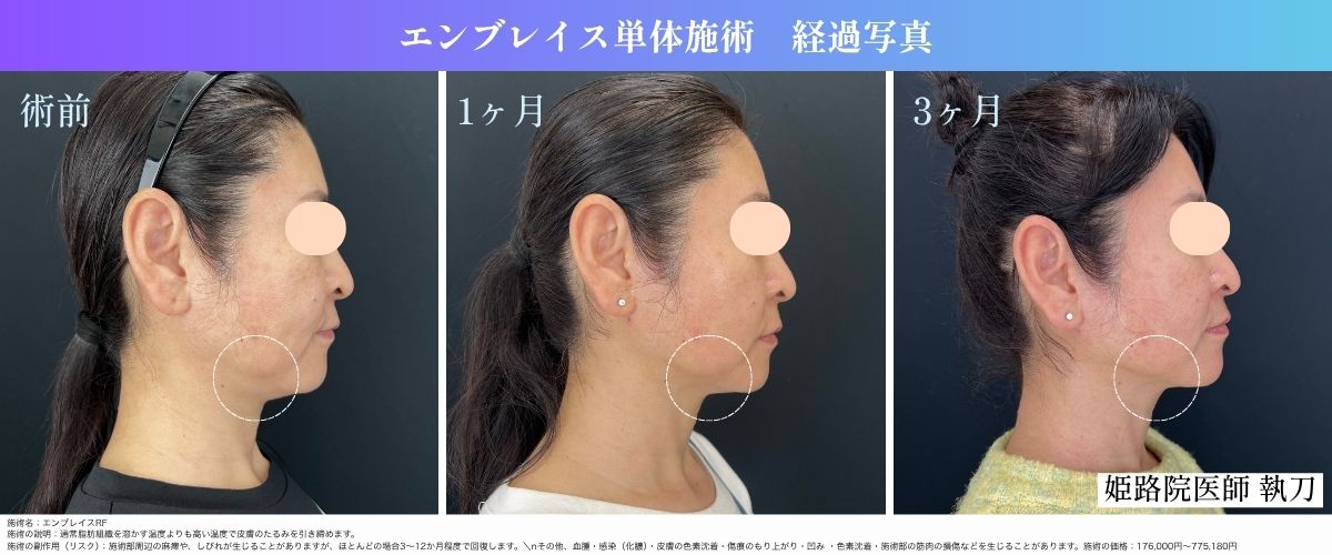 たるみ治療の最終兵器💖