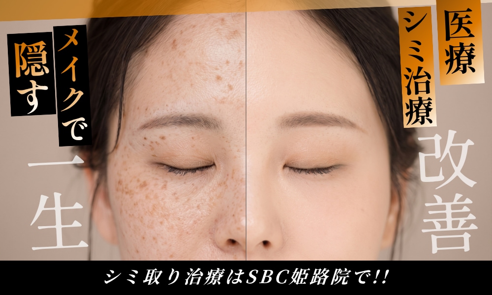 隠す厚塗りメイク卒業！ SBC姫路院で始める、失敗しない「シミ無料診断」
