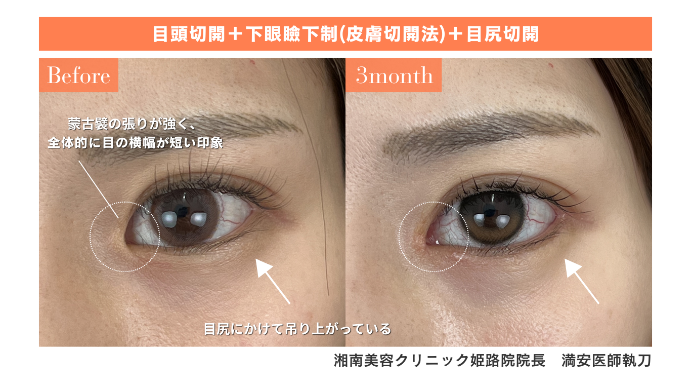 目頭切開