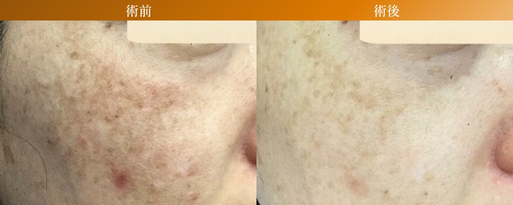 フォトダブルの症例写真（Before/After）｜湘南美容クリニック
