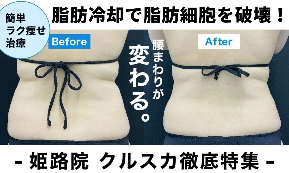 【姫路院クルスカ徹底特集】簡単部分痩せクールスカルプティングエリート！気になる脂肪撃退の最新メソッド！