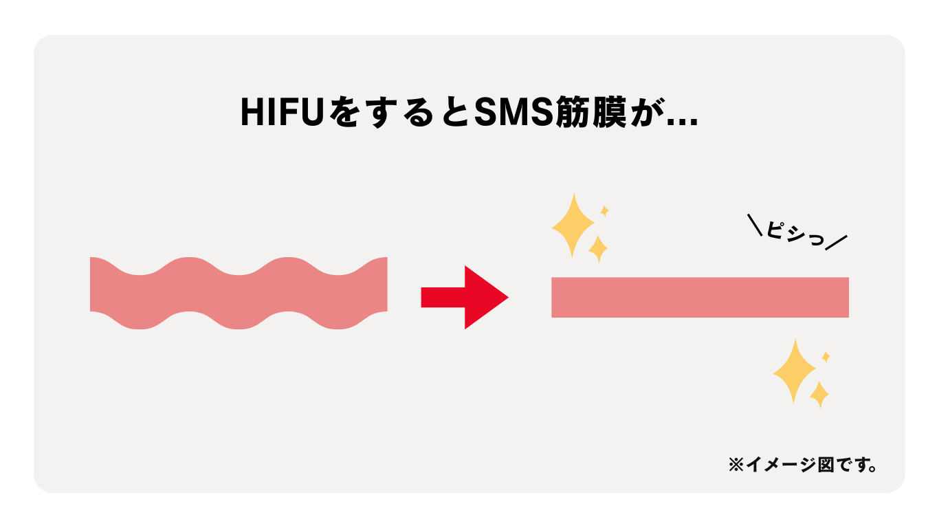 糸＋HIFU