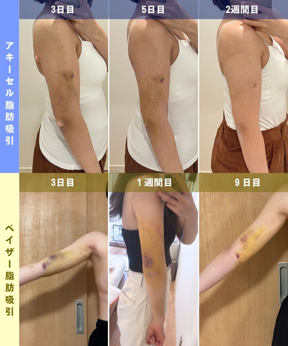 二の腕ダウンタイム比較