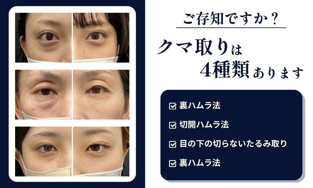 《クマとりが4種類あるの、ご存知ですか？》