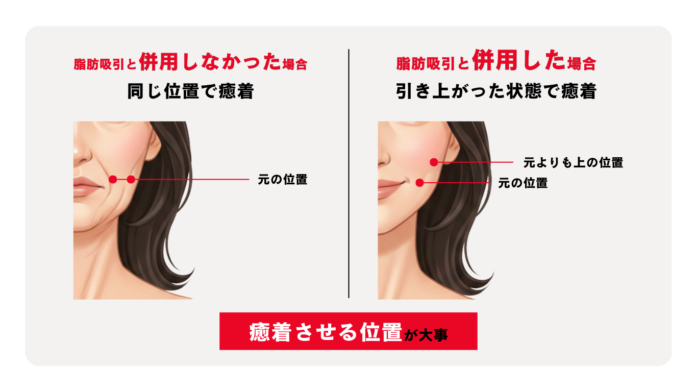 糸＋脂肪吸引または脂肪吸引注射