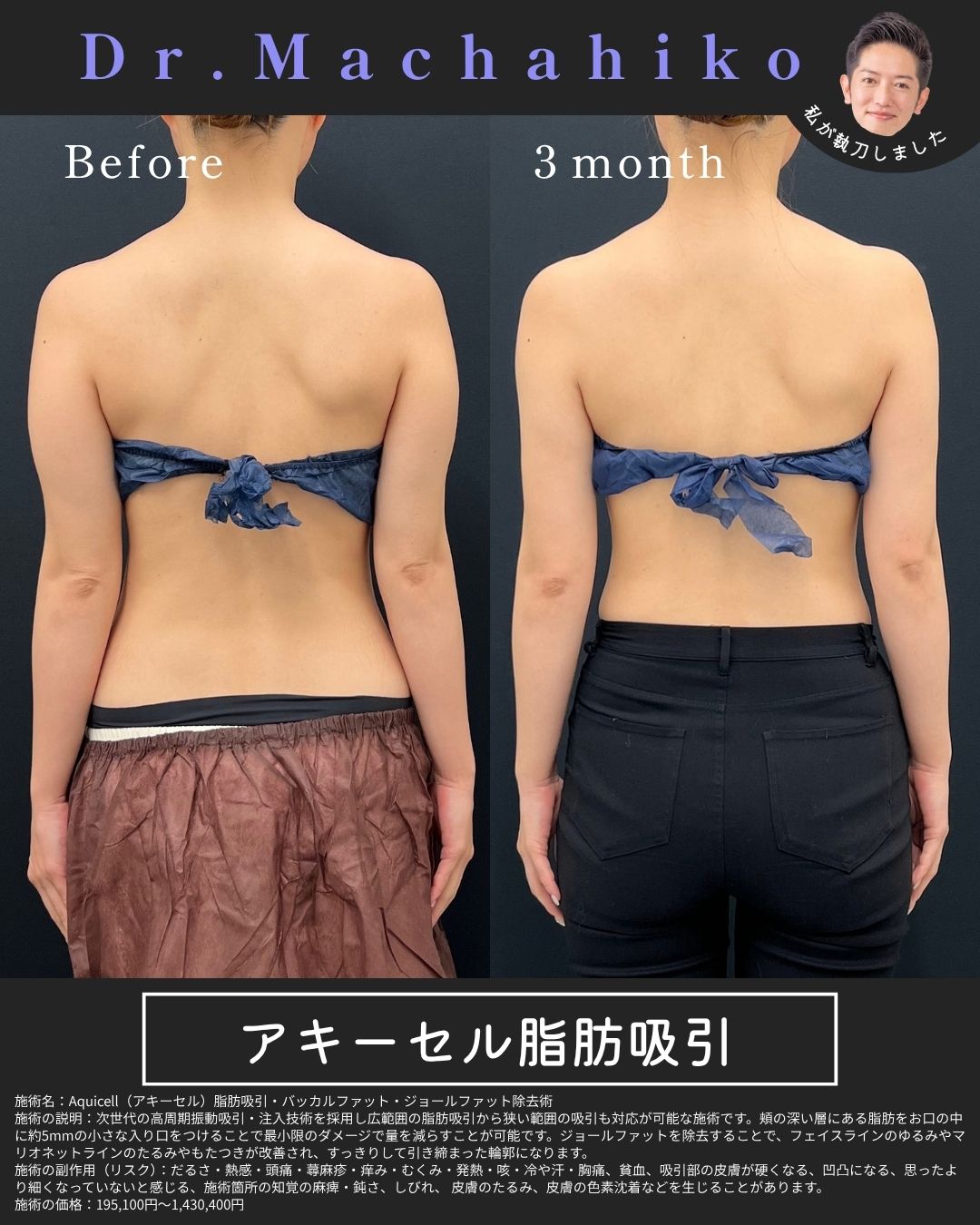アキーセル脂肪吸引 二の腕 症例