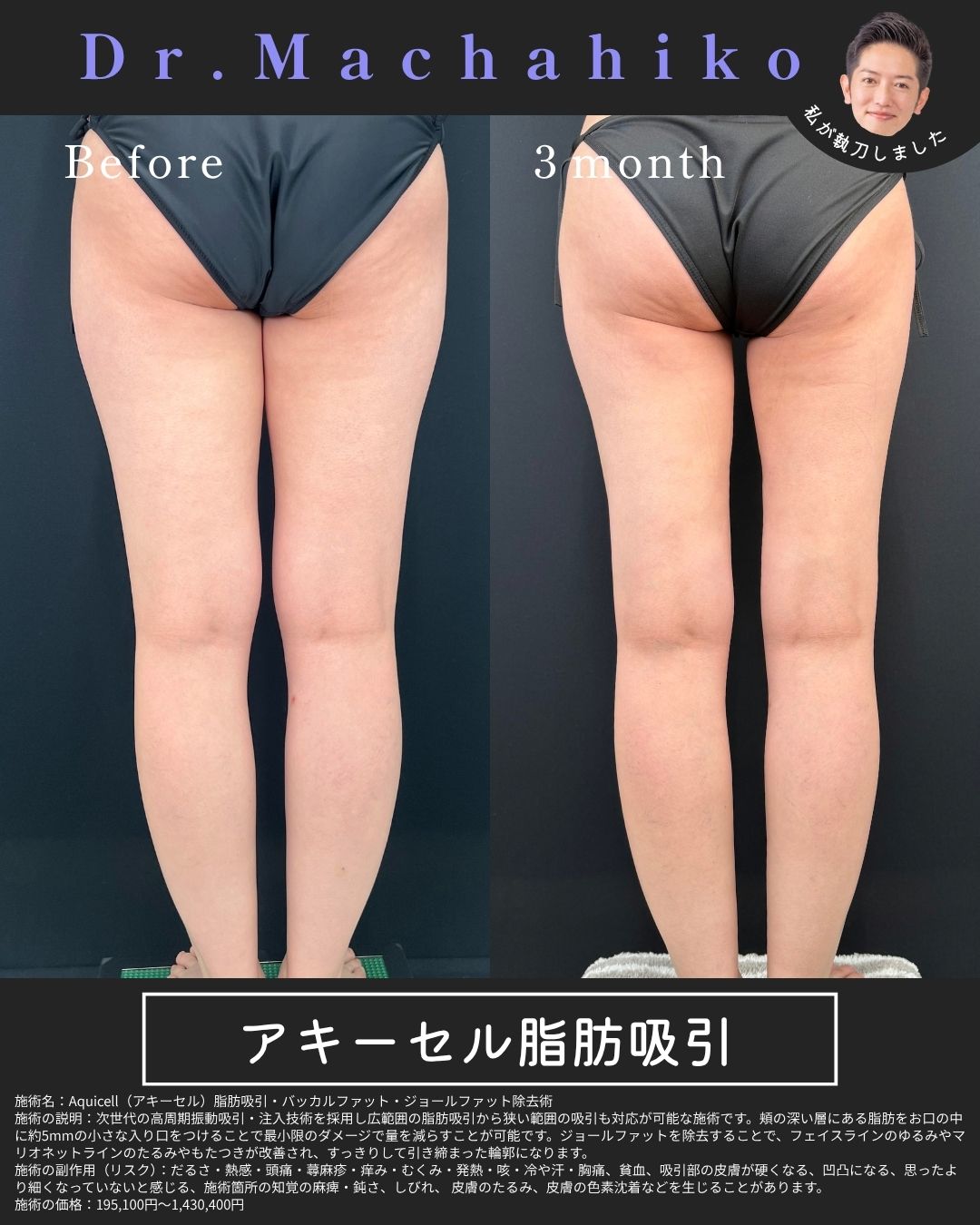 アキーセル脂肪吸引 太もも 症例
