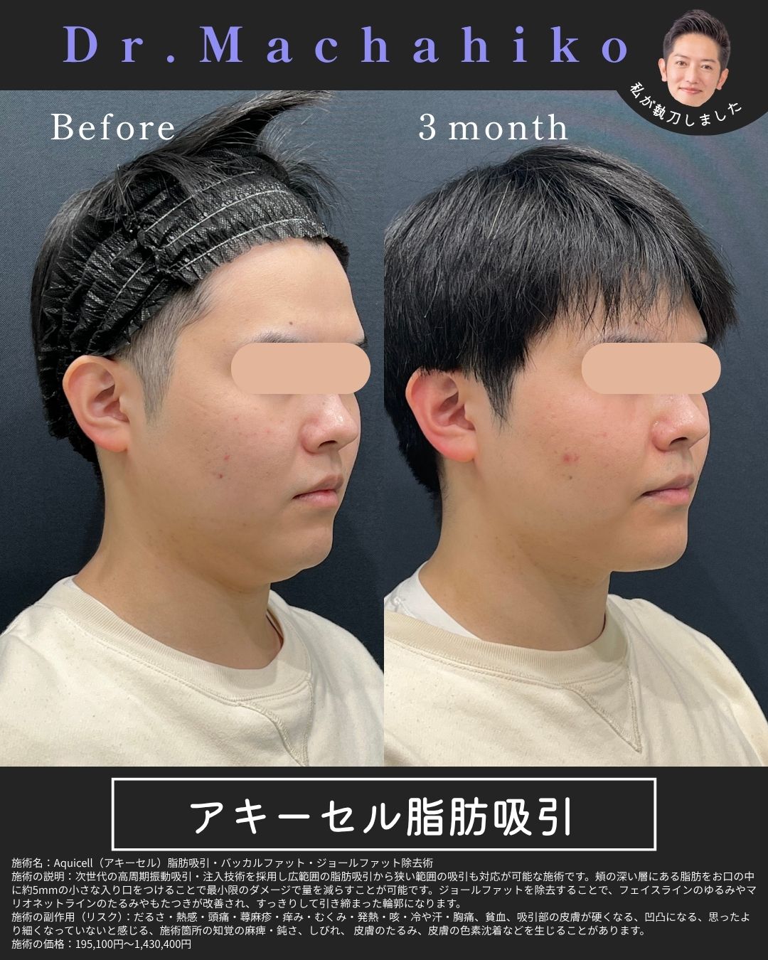 アキーセル脂肪吸引 顔 症例