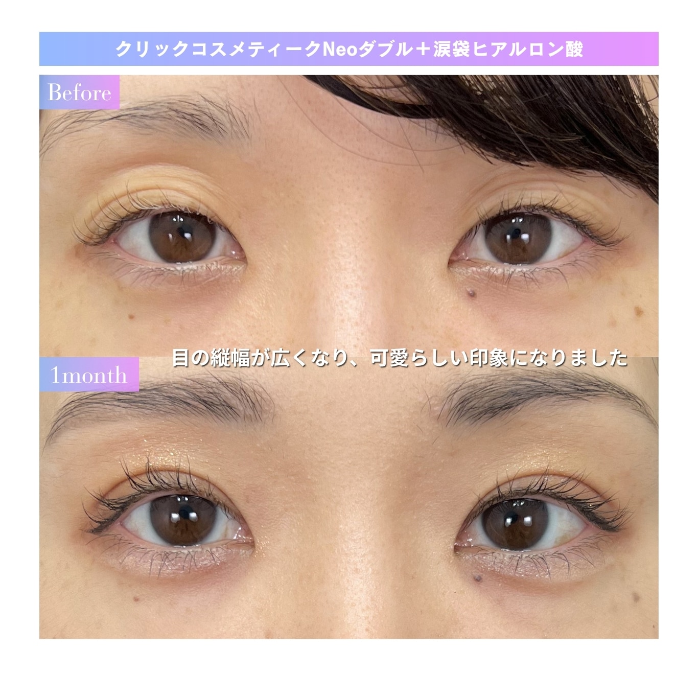 涙袋ヒアル