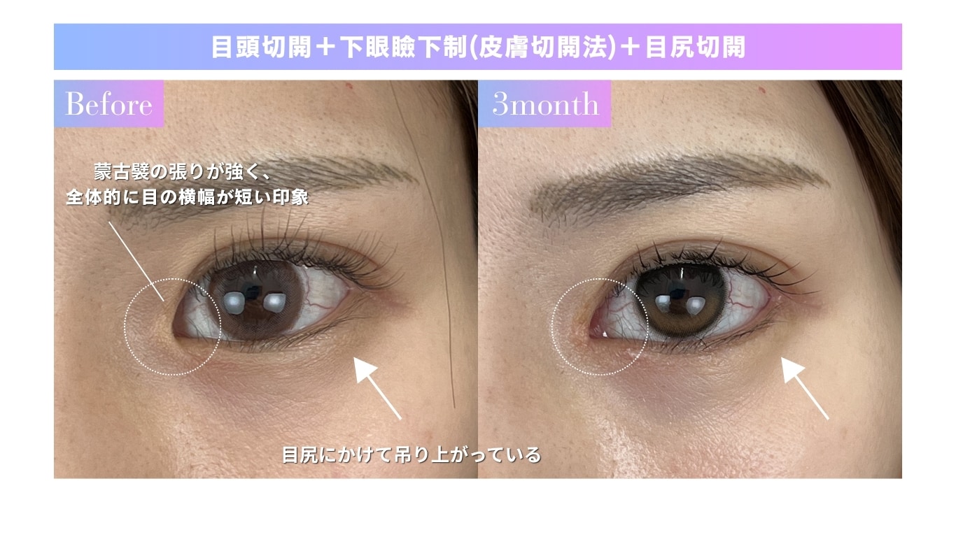 目頭切開