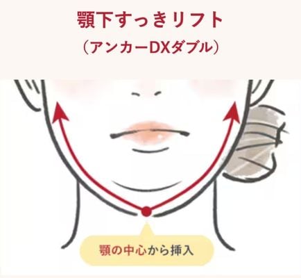 アンカーDXダブルとは？