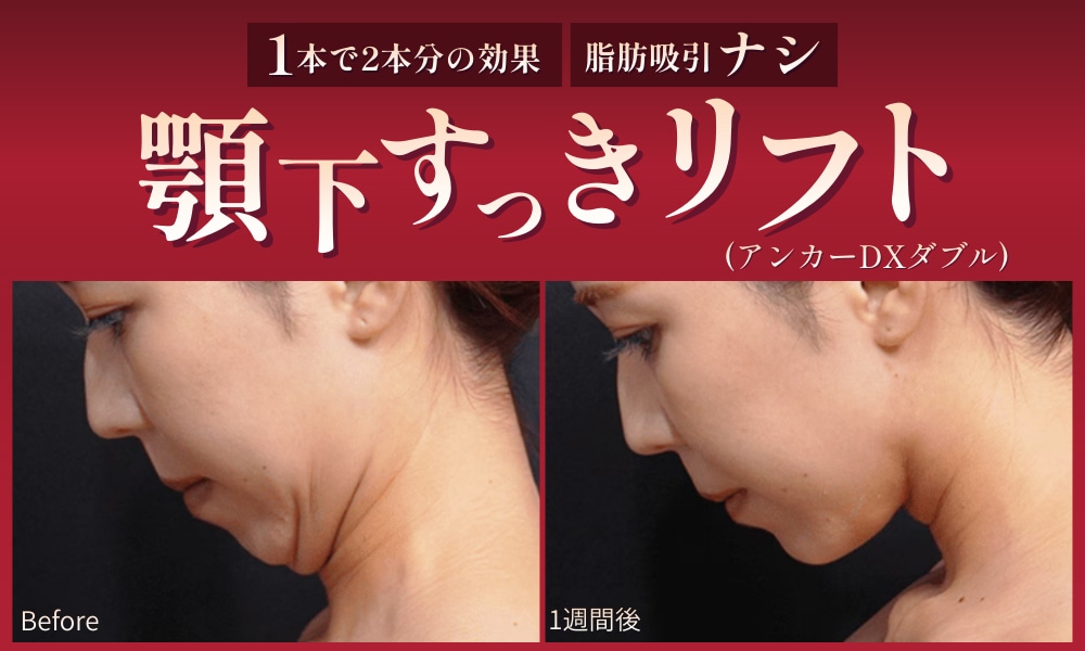 兵庫で二重あご解消なら【顎下すっきリフト】姫路院に新導入！切らない小顔術