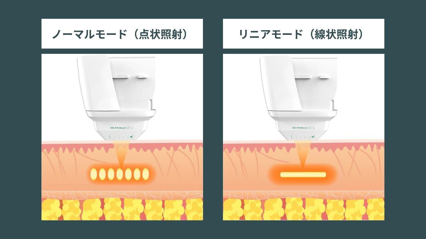 「ドット」×「リニア」の使い分けで、引き締めと脂肪減少を同時に
