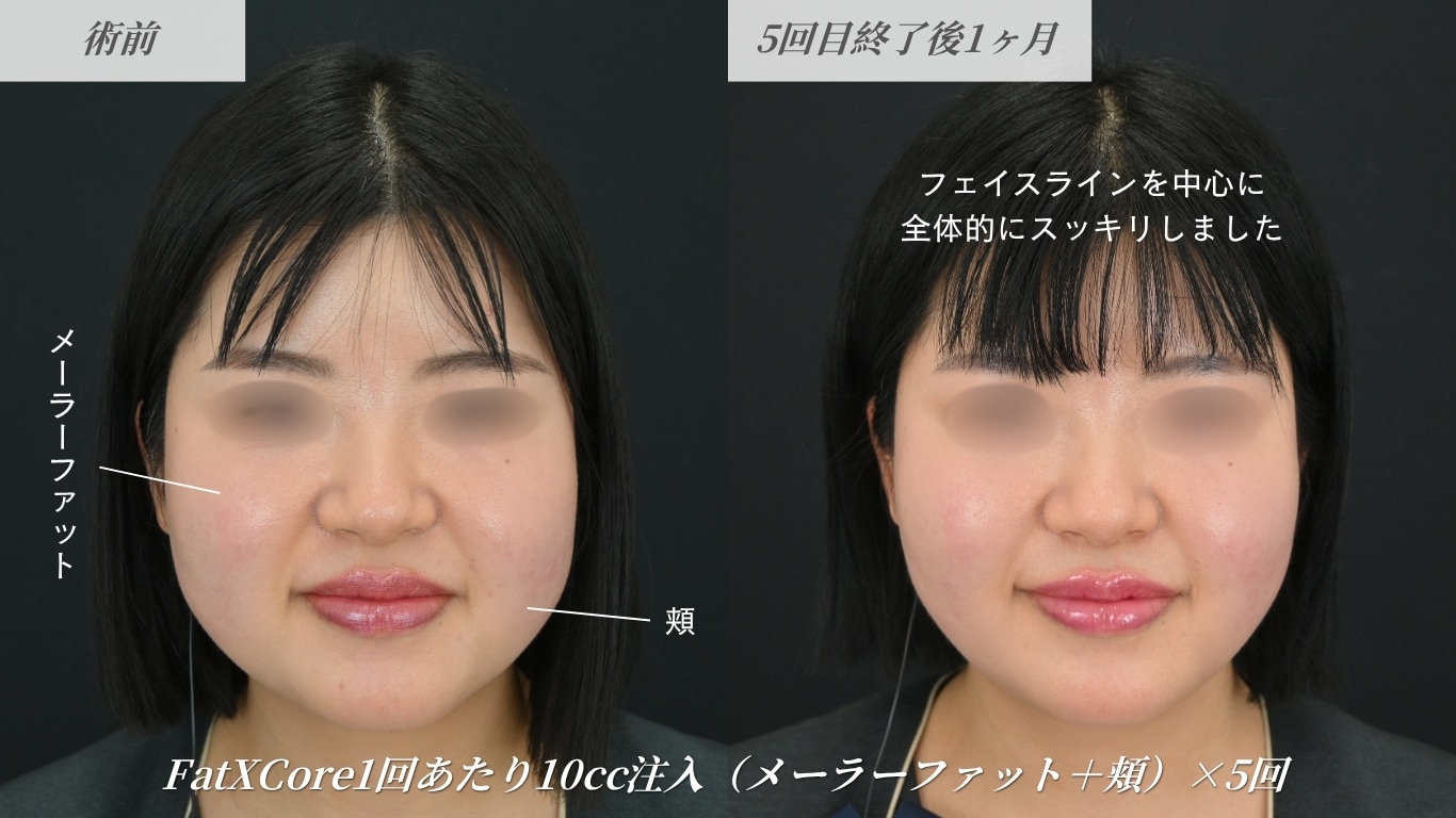 FatX Coreの症例写真