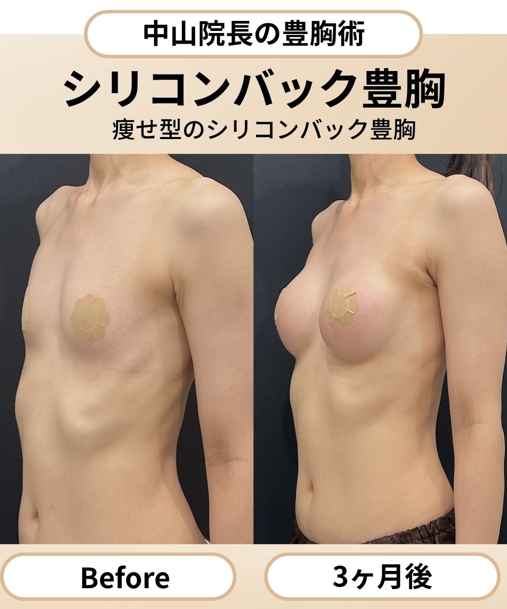 【症例3】シリコンバッグ豊胸