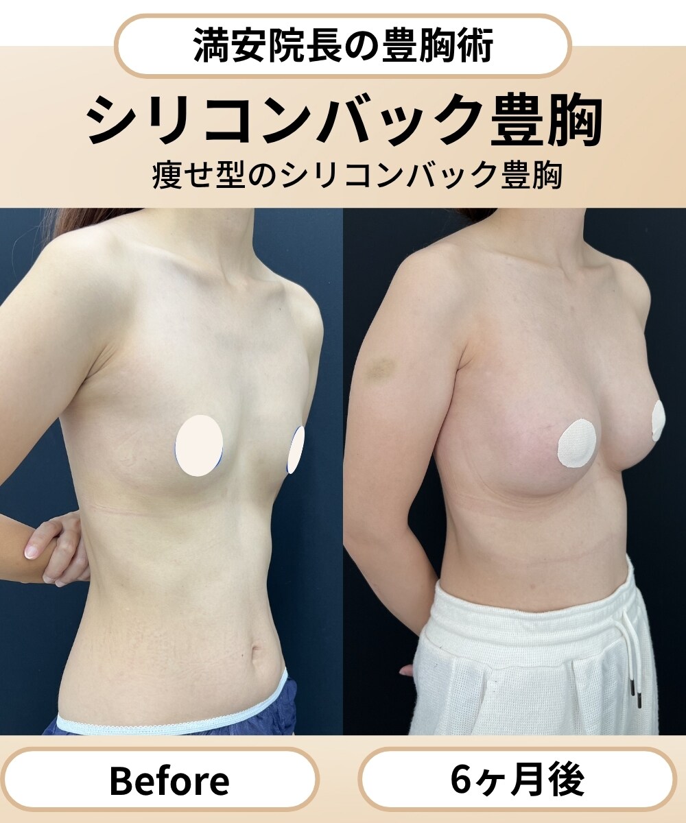 【症例2】シリコンバッグ豊胸