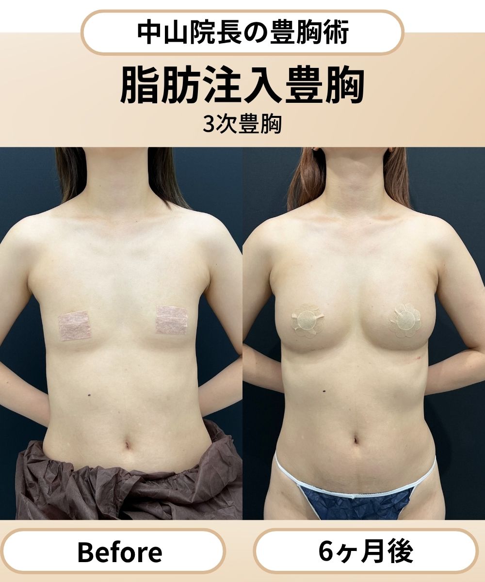 【症例2】脂肪注入豊胸
