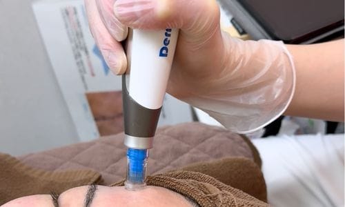 自分の肌が持つ「生まれ変わる力」をぐっと引き出す治療
