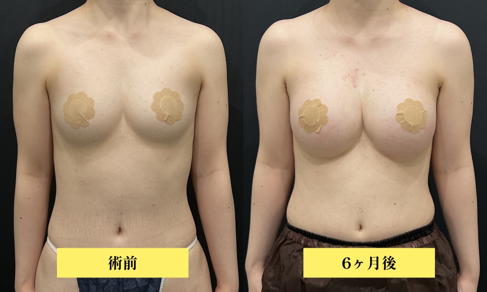 ハイブリッド豊胸<br />
（シリコンバッグのボリューム×脂肪の極上の柔らかさを掛け合わせた最高峰の豊胸術）