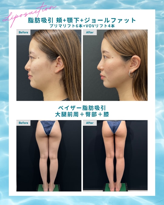 📷中山院長によるアゴ下・太ももお尻 の脂肪吸引 Before/After
