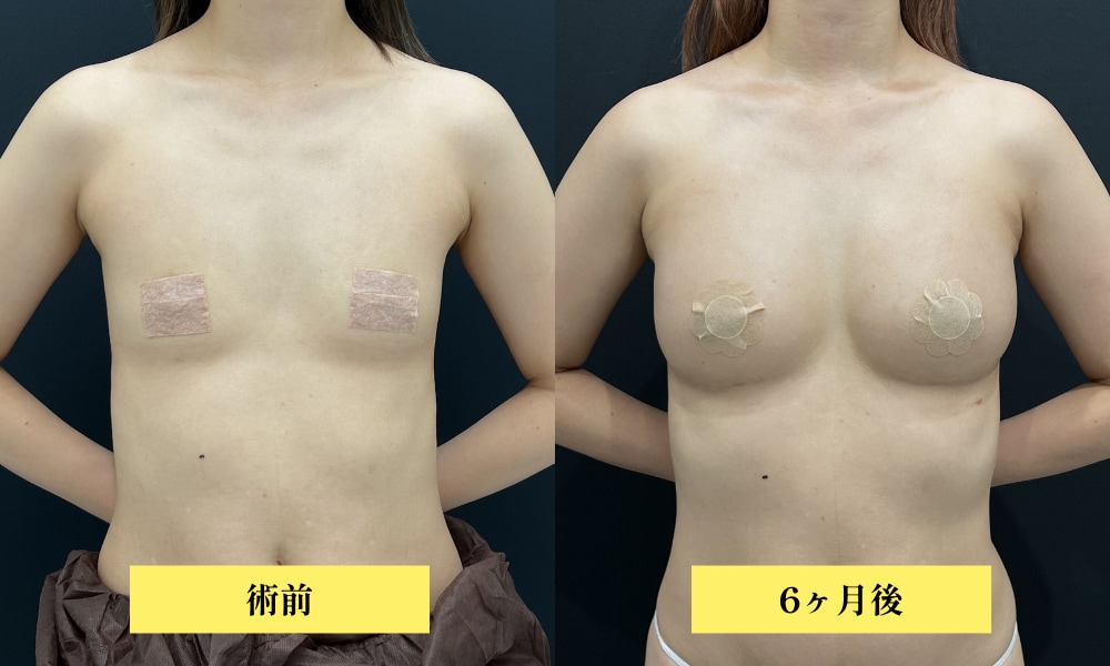 脂肪注入豊胸<br />
（触り心地も見た目も完全な本物・部分痩せも同時に）
