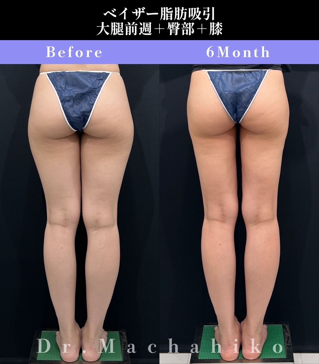 【大腿・臀部・膝の症例】骨格に合わせた隙間と、滑らかなボディライン