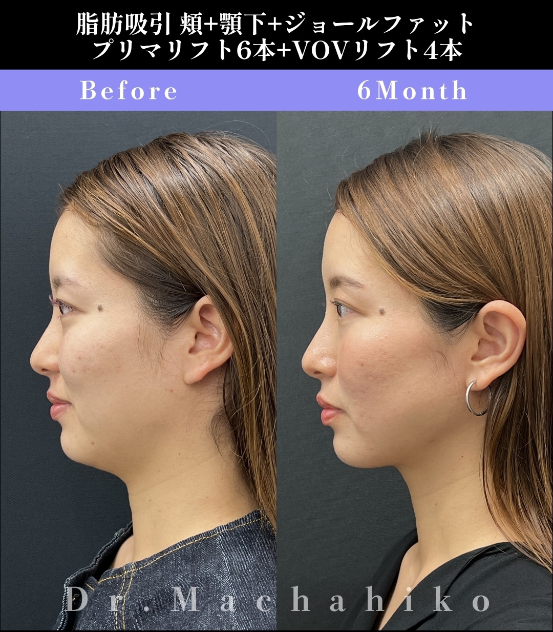 【顔（ホホ・アゴ）の症例】たるみを防ぎ、二重顎解消