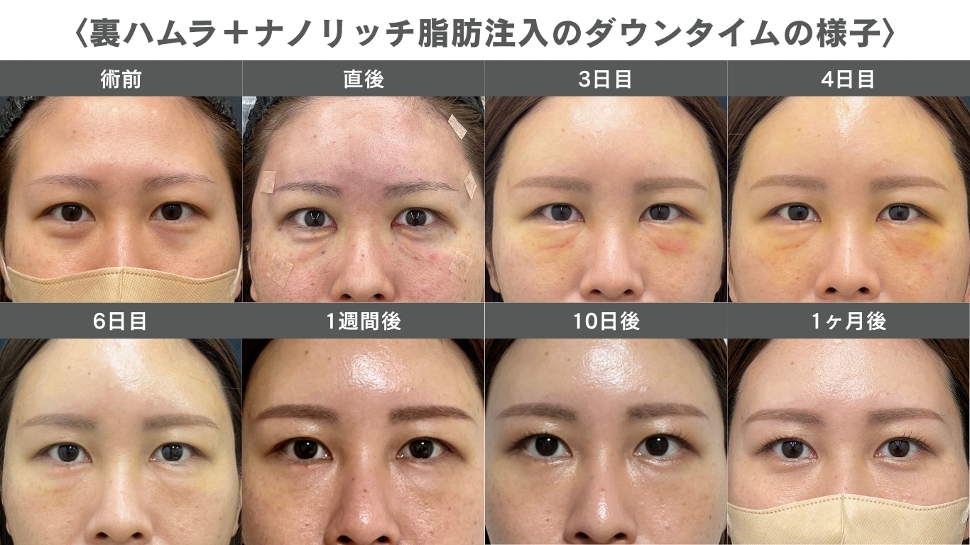 ダウンタイム中の腫れや<br />
内出血の経過と仕事への影響